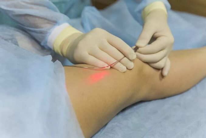 Zdravljenje varikoznih žil z laserjem