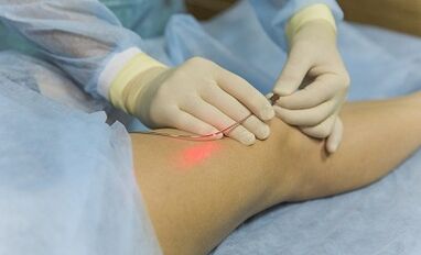 Zdravljenje varikoznih žil z laserjem