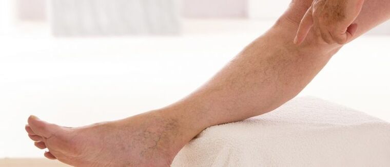 Krčne žile na nogah